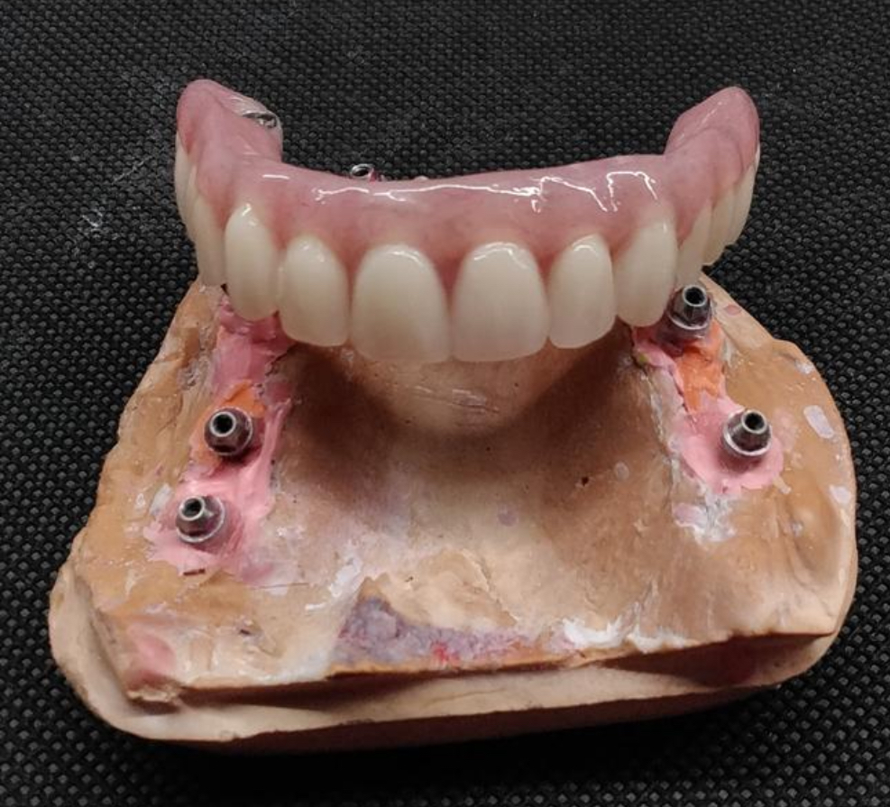 Implant hybrid Denture 